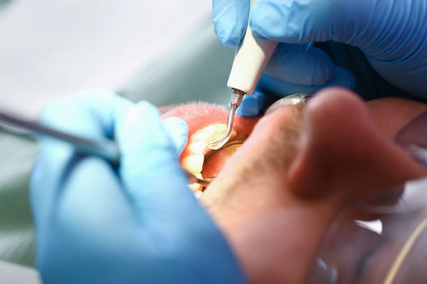Best Dentist for Tooth Abscess  in Toro Nyon, CA
