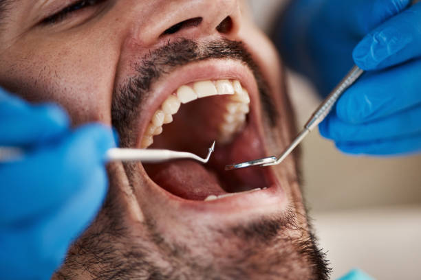 Best Urgent Tooth Repair  in Toro Nyon, CA