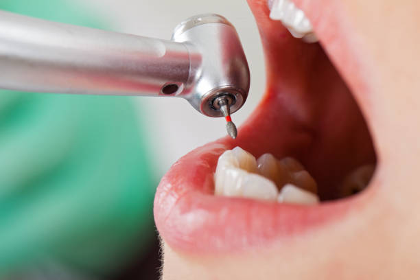 Best Emergency Gum Pain Relief  in Toro Nyon, CA